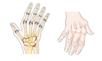 rheumatoid arthritis