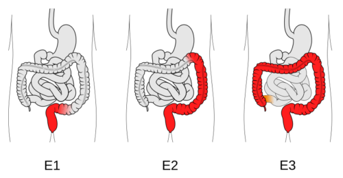 Ulcerative Colitis