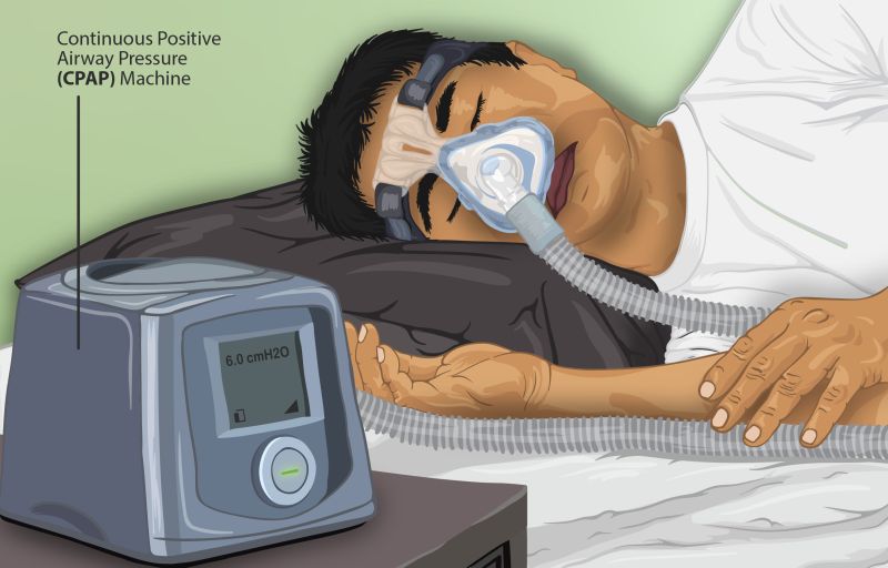 sleep apnea case study